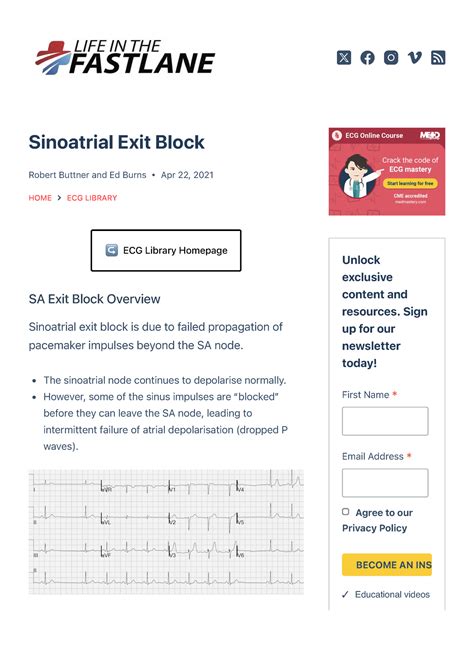 Sinoatrial Exit Block • Litfl • ECG Library Diagnosis - Sinoatrial Exit ...