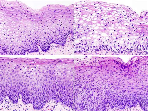 Cervical Intraepithelial Neoplasia