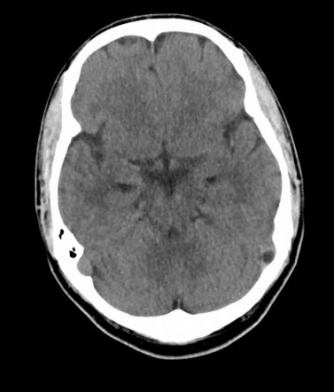 Arachnoid granulation | Radiology Reference Article | Radiopaedia.org