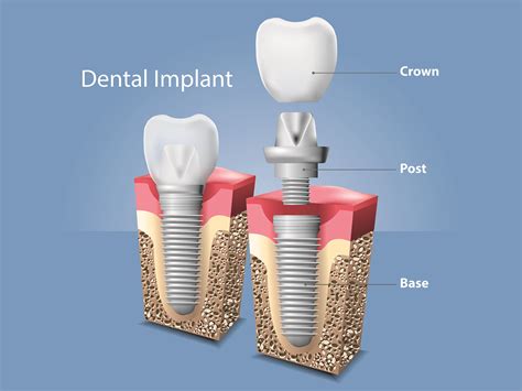 Dental Implants Procedures | Richard A. Urbanek Jr. DDS, MS, PA | Wichita Falls, TX