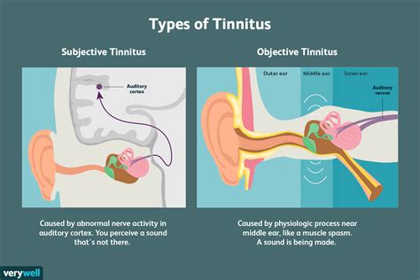 Tinnitus (Ringing in the Ears): Causes, Treatment and More