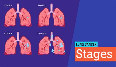 Stages of Lung Cancer | MyLungCancerTeam