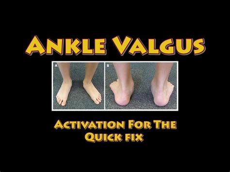 Valgus Vs Varus Of Ankle