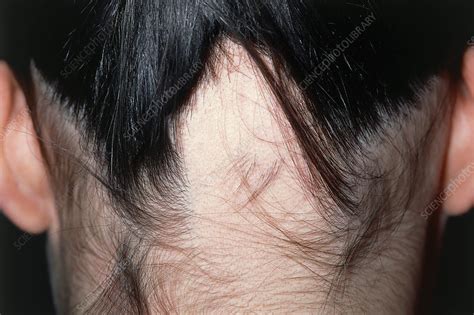 Alopecia areata hair loss - Stock Image - M108/0544 - Science Photo Library