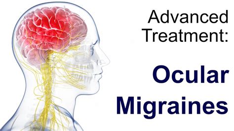 Ocular Migraine Patterns