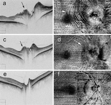 Images of a right eye with NAION: high definition raster images are on ...