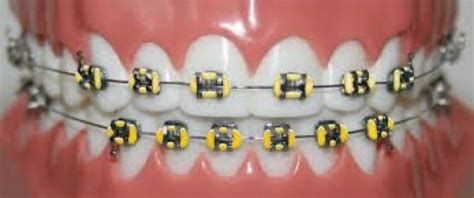 yellow colored braces! #braces #braces #aesthetic | Braces colors, Cute braces colors, Cute braces