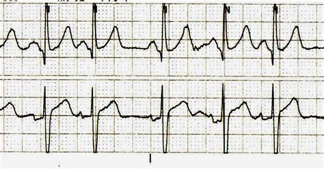 ECG Channel: Sinoatrial Block or Sinoatrial Exit Block