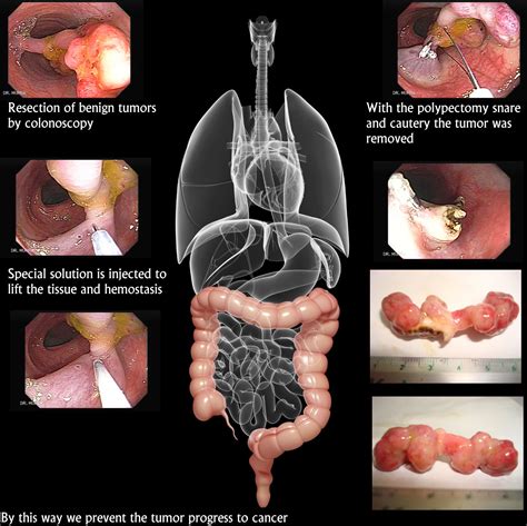 Polyps - Notes on Cyber Gastroenterology - murrasaca.com