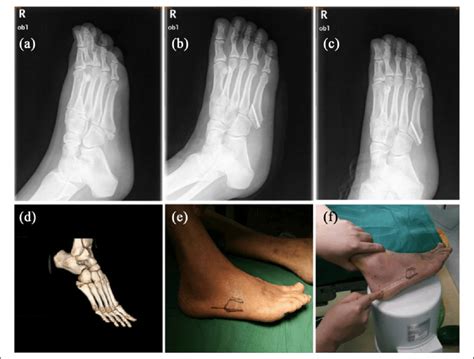 (a) The fifth metatarsal base avulsion fracture confirmed by X-ray. (b)... | Download Scientific ...