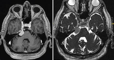 Trigeminal neuralgia due to petroclival meningioma – upfront radiosurgery | Radiology Key