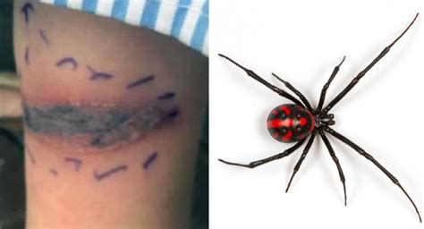 Black Widow Spider Bite Pictures - pic-nugget