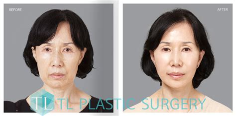 SMAS FACELIFT - TL ANTI-AGING LIFTING KOREA