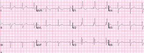 Dr. Smith's ECG Blog: Right Bundle Branch Block. What else?