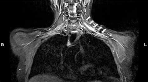 Brachial plexus MRI, contrast media enhancement was shown at left... | Download Scientific Diagram