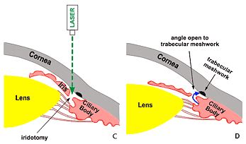 NARROW ANGLES – Toronto Eye Clinic