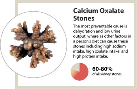 Kidney stones - a marker of overall kidney health - News | UAB