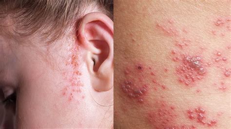 10 Rashes That Could Reveal a Dermatologic Disease » | Types of rashes, Psoriasis rash ...