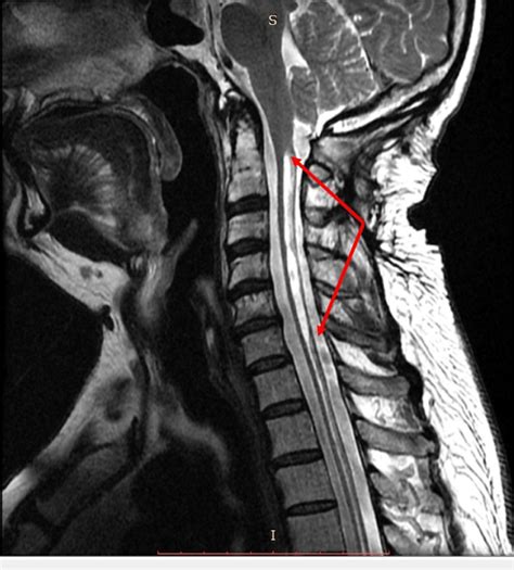 Sagittal Mri C Spine T2 With Structures Labeled Mri Mri Study | Images and Photos finder