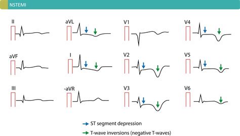 NSTEMI (Non ST Elevation Myocardial Infarction) & Unstable Angina: Diagnosis, Criteria, ECG ...