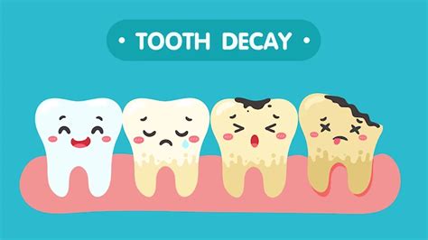 Tooth Decay: Here's How You Can Reverse It Easy Ways | OnlyMyHealth