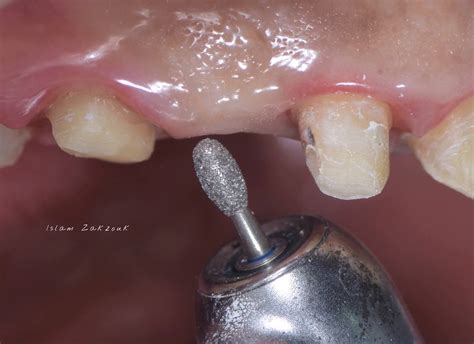 Dental Esthetics: Ovate pontic for the correct emergence profile.. A clinical case