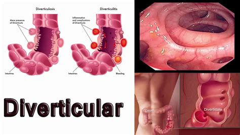 Diverticulitis Treatment Remedy and Cure || cure diverticular disease ...