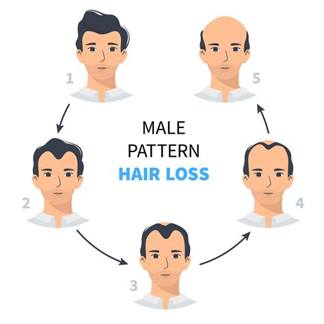 Hair loss stages, androgenetic alopecia male pattern. Steps of baldness vector infographic in a ...