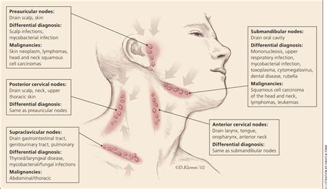 Unexplained Lymphadenopathy: Evaluation and Differential Diagnosis | AAFP