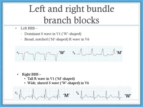 Right V Left Bundle Branch Block