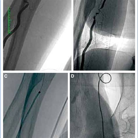 (A) Radial artery loop and spasm. (B) Radial loop straightened with a ...