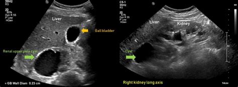 Ultrasound features of Kidney Cysts - Renal Fellow Network