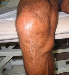 1000+ images about Bursitis of the knee on Pinterest | Bursa, Bursitis knee and Knee injury