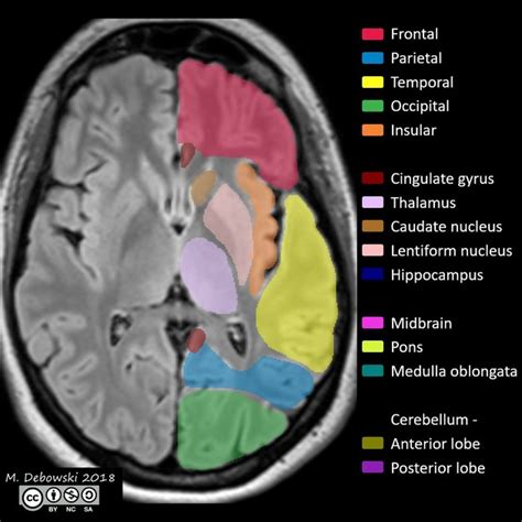 Brain Anatomy On Mri - Anatomical Charts & Posters