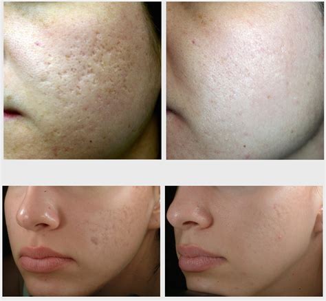 Effective Acne Scar Treatment For Brides To Be - Feel Good Laser and Skin