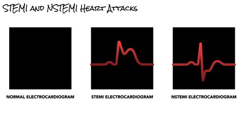 Normal Ecg Vs Heart Attack Ecg