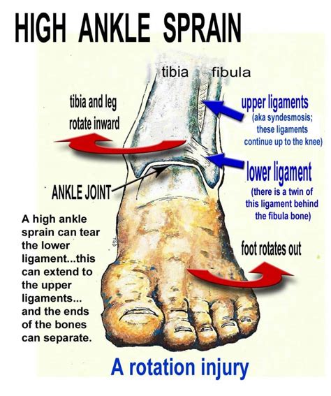 suave Impulso admiração sprained ankle pain moving up leg Durante ~ Soluçando Ajustável