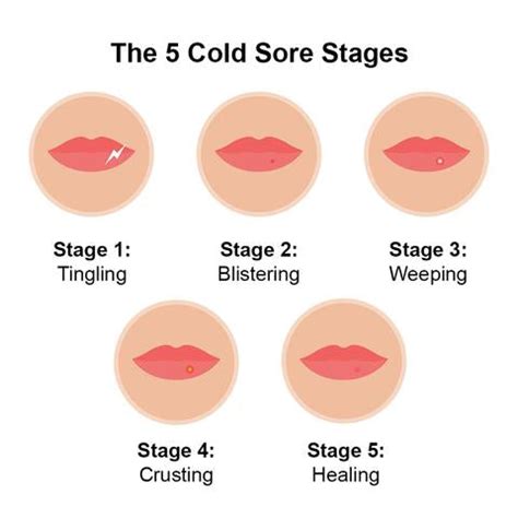 Cold Sore Blister Stage