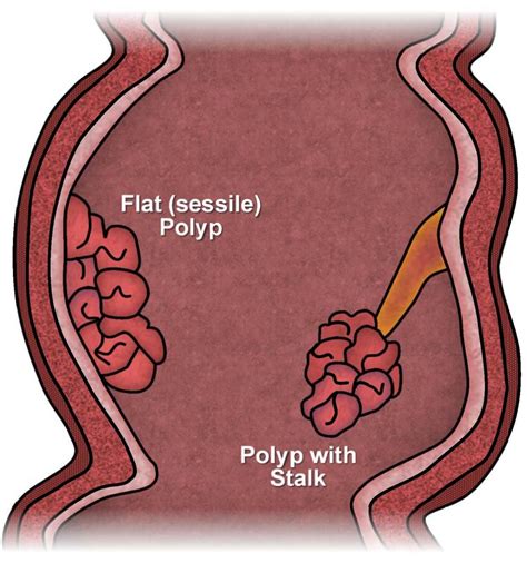 Pin on The Best Colonoscopy Los Angeles