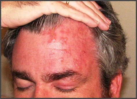 Shingles on forehead pictures | Shingles Expert