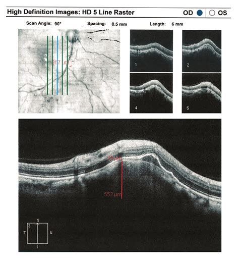 Imaging a choroidal nevus