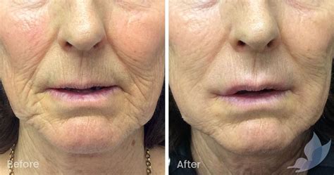 Fine Lines and Wrinkles Before and After Gallery - Austin Clinic