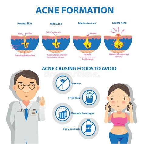 Acne. Formation Info Graphic and diagrams.Vector illustrations , # ...