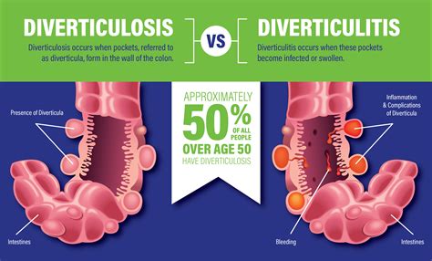 Diverticulitis_VS_Diverticulosis_Blog - Lakeland Surgical & Diagnostic ...