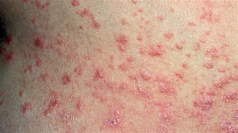 Is That Rash Psoriasis? Psoriasis Pictures and More | Everyday Health