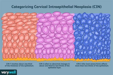 Cervical Intraepithelial Neoplasia: Signs & More