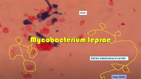 iehl-Neelsen Stain for Mycobacterium leprae: Introduction, Principle, Proce