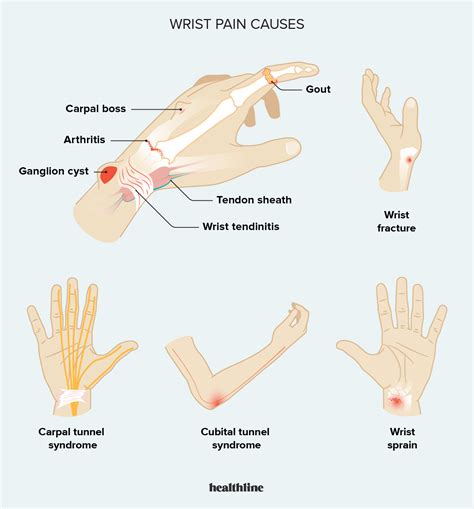 Ulnar Wrist Pain Causes