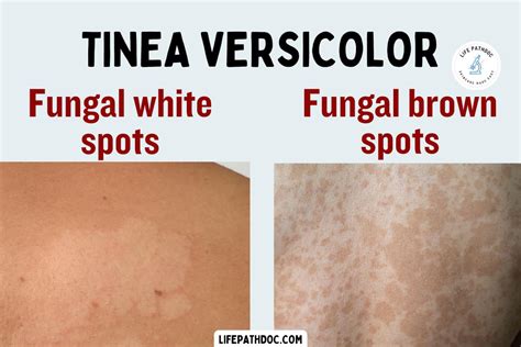 Tinea Versicolor: Brown spots or White patch on skin by fungus