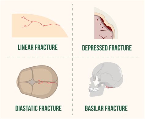 Infant Skull Fracture Lawsuit | Types Of Skull Fracture In Babies